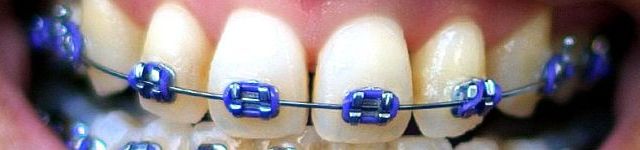 In ce consta tratamentul ortodontic si cand avem nevoie de el?